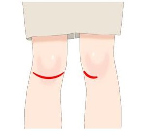膝の痛みを自分で治すには、膝関節のアライメントを整える事が大切です