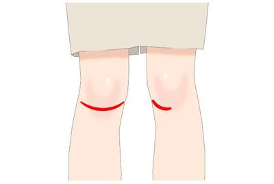 膝関節のアライメントを整える
